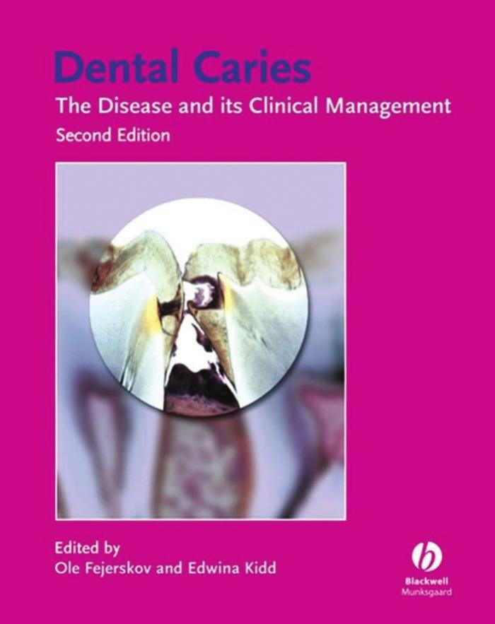 Dental Caries: The Disease and its Clinical Management. Second Edition